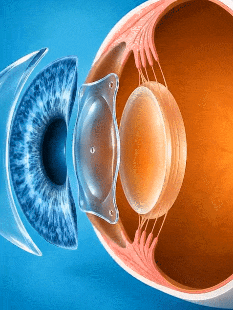 Animation of an EVO ICL lens being placed in the eye